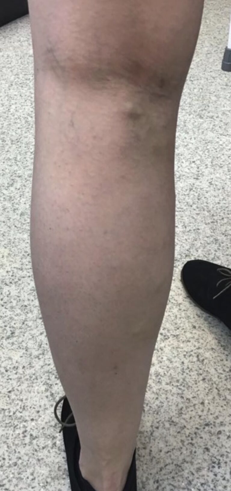 Same lower leg following treatment showing reduced visible varicose veins.