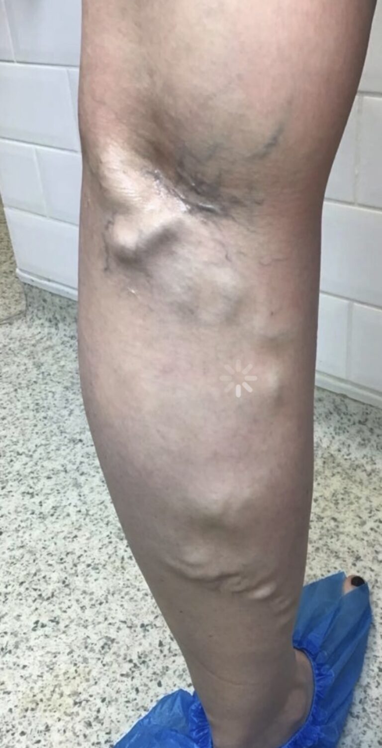 Lower leg before treatment showing visible varicose veins on the calf and ankle.