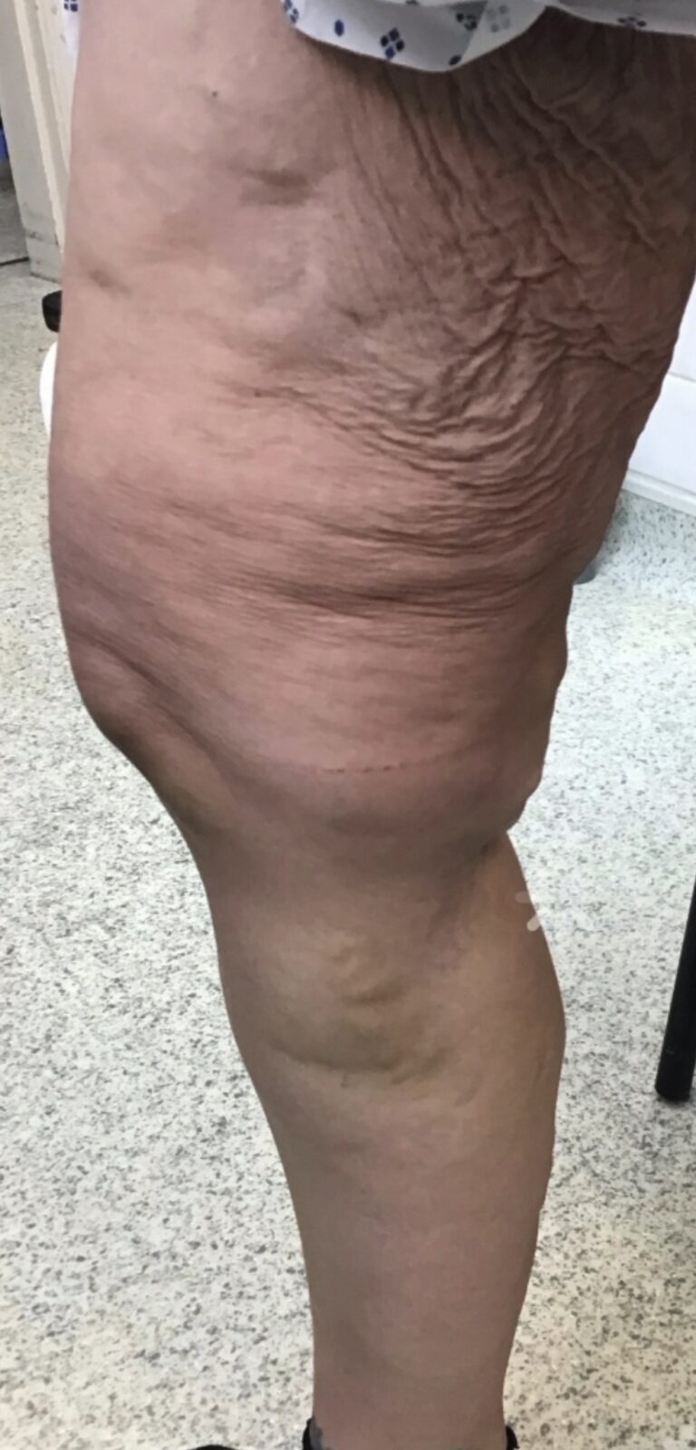 Same leg following treatment showing reduced varicose veins around the knee.