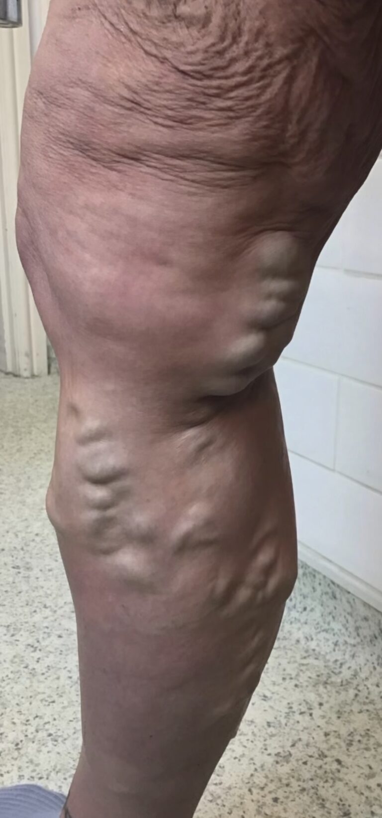 Leg before treatment showing prominent varicose veins around the knee and upper calf.
