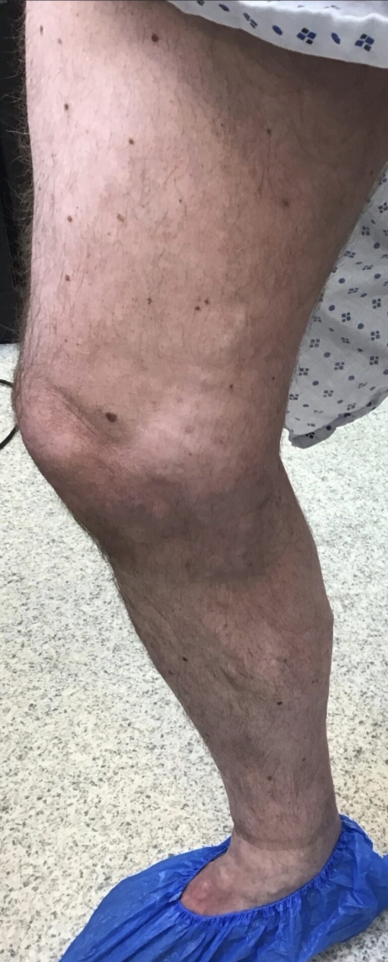 Same lower leg following treatment showing reduced visible varicose veins, with some post-treatment bruising visible.