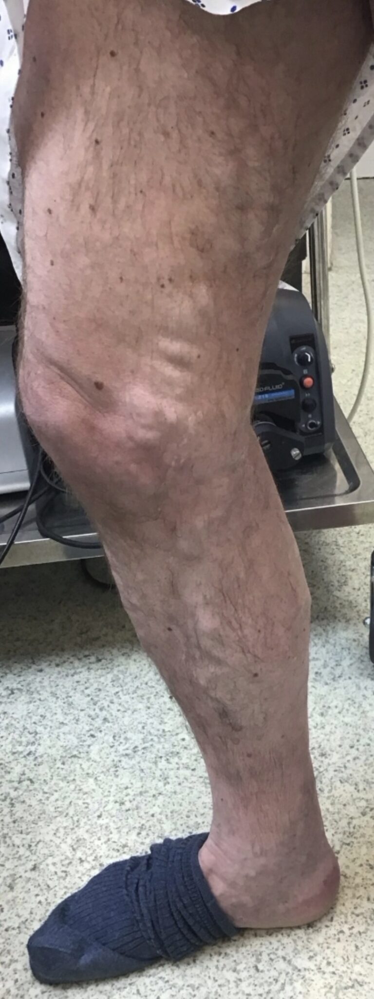 Lower leg before treatment showing visible varicose veins on the calf.