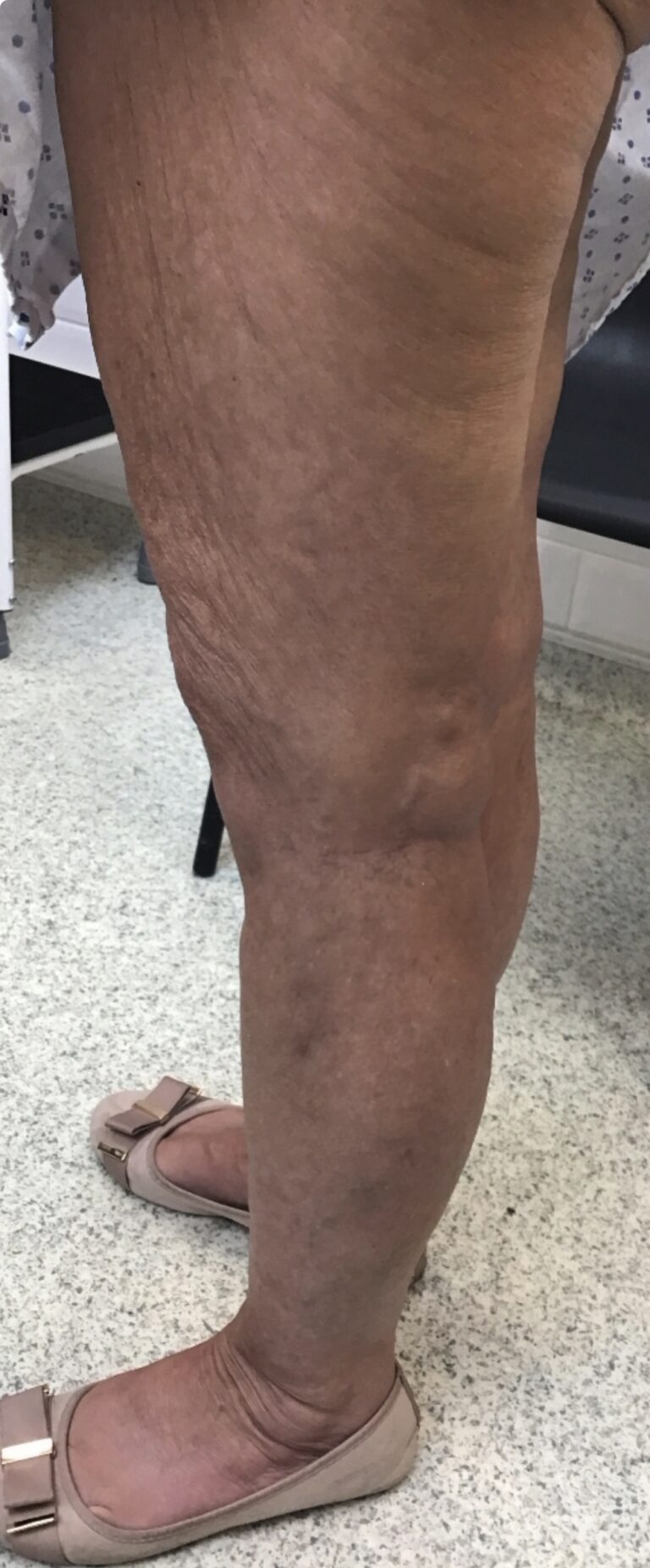 Same leg following treatment showing reduced visible varicose veins on the calf.
