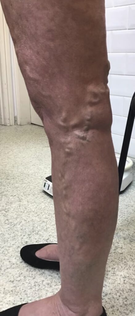 Leg before treatment showing prominent varicose veins on the calf.