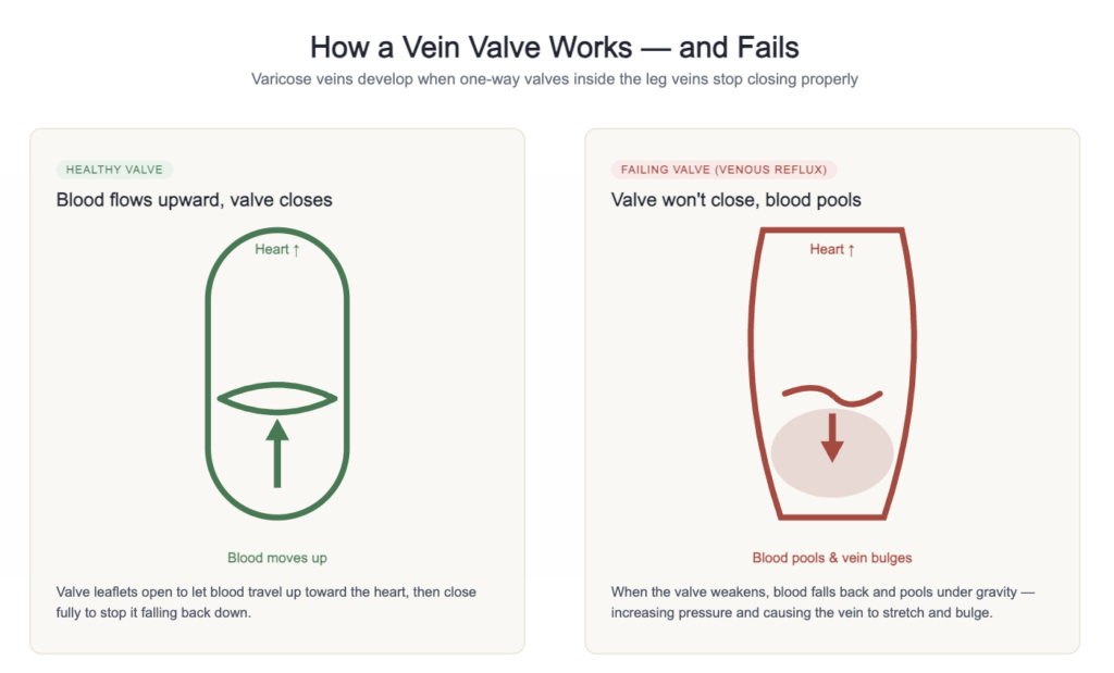 Diagram showing a healthy vein valve directing blood upward compared to a failing valve allowing blood to pool and the vein to bulge