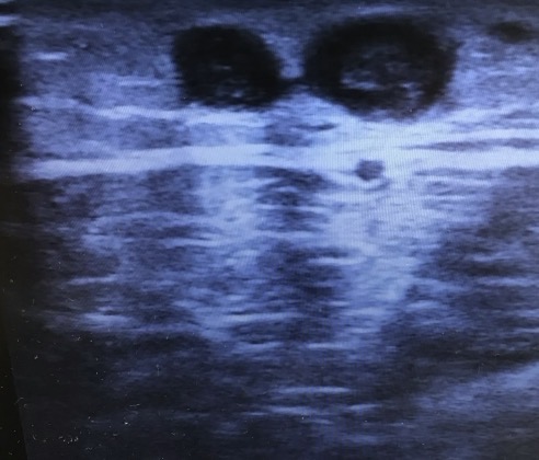Duplex ultrasound scan of the affected varicose vein used to confirm the superficial clot