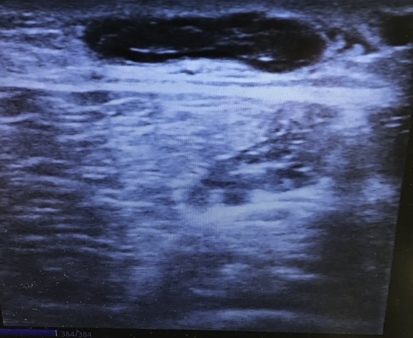 Second duplex ultrasound view confirming the extent of the thrombus in the superficial vein