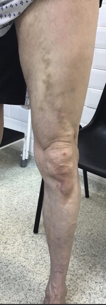 Leg following EVLA treatment, follow-up view showing resolved thrombophlebitis and vein
