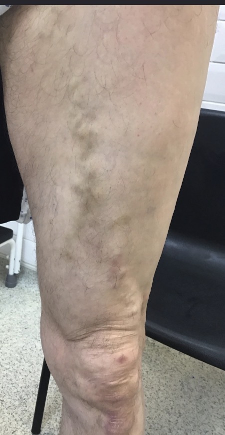 Later follow-up view after EVLA treatment showing the leg almost fully healed