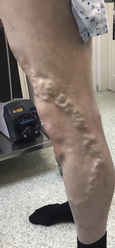 Varicose vein with thrombophlebitis before EVLA treatment