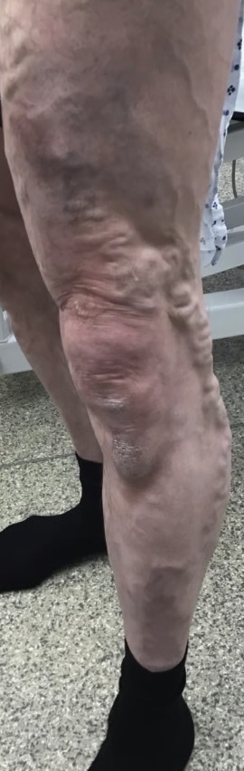 Close-up of the thrombophlebitic segment of the varicose vein, marked out ahead of treatment