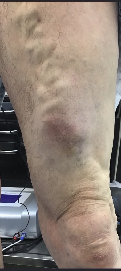 Inflamed, thrombophlebitic superficial varicose vein on the lower leg before treatment, showing redness and discolouration tracking the vein