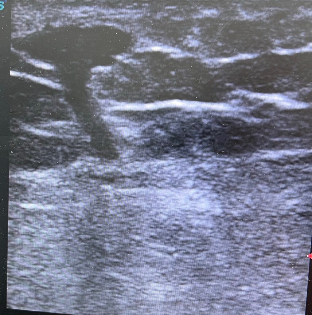 Duplex ultrasound demonstrating an incompetent posterior thigh perforating vein