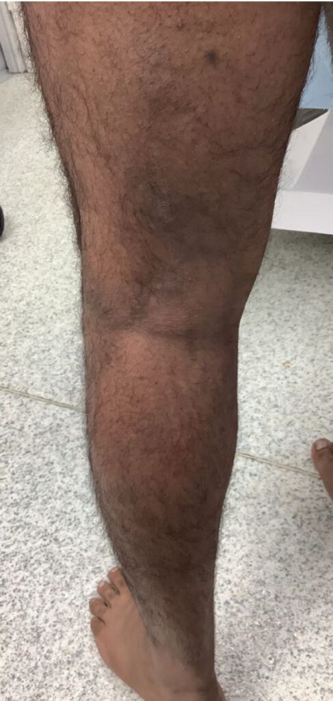 Posterior thigh and leg after treatment of perforator-related varicose veins