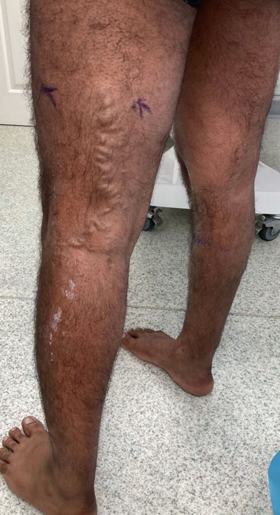 Posterior thigh and leg varicose veins caused by an incompetent perforating vein before treatment