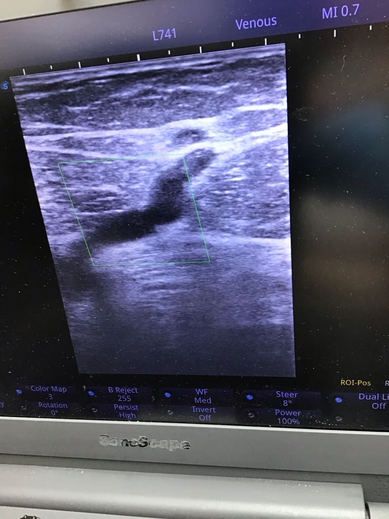 Duplex ultrasound showing an incompetent calf perforator vein