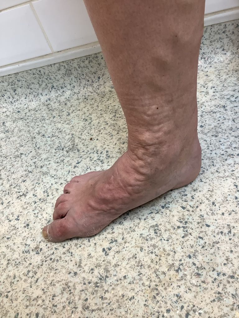 Varicose veins extending across the ankle and foot before treatment