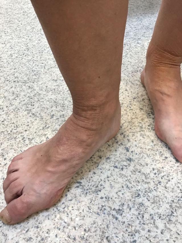 Right foot after treatment showing marked reduction in visible varicose veins