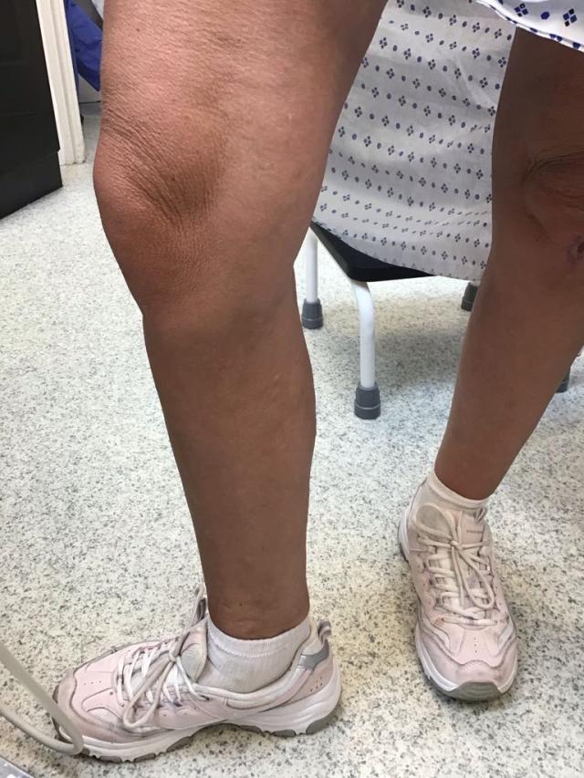Right lower leg following EVLA and perforator treatment
