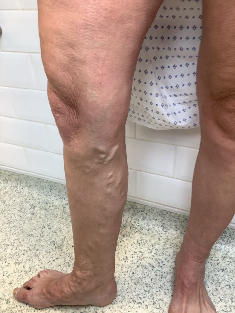 Pre-treatment recurrent varicose veins extending down the right lower leg